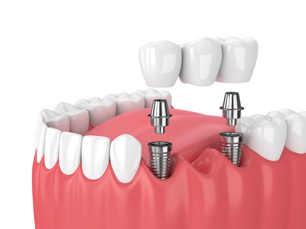 Dental Bridges in Leland, North Carolina