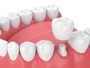 Dental Crowns Step by Step