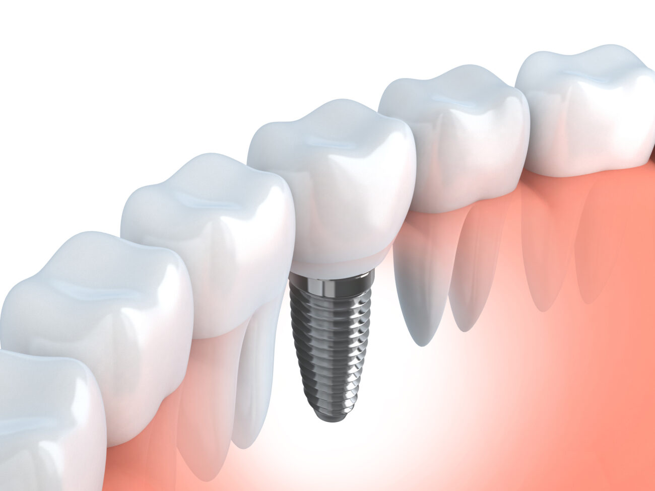 single dental implant in Leland, NC