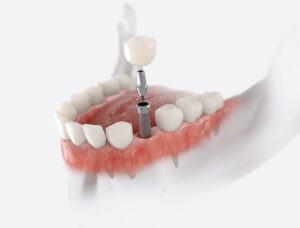 Restoring a dental implant becomes crucial when issues arise. Ignoring such problems can lead to complications.